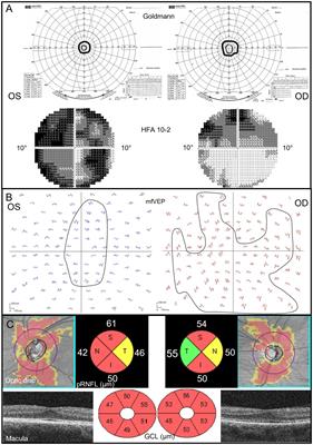 Case report: Bilateral damage to the immature optic radiation and secondary massive loss of retinal ganglion cells causing tunnel vision